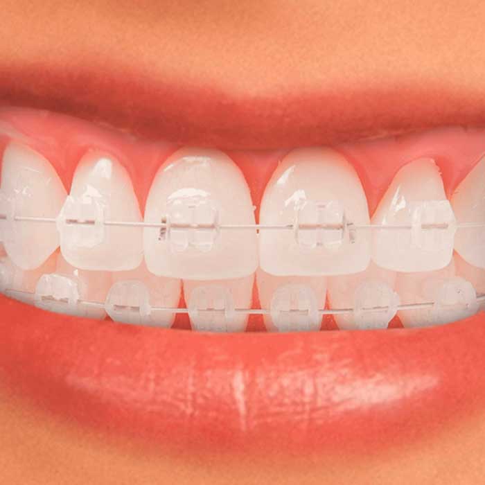 Ortodoncia Transparente Brackets Est ticos Transparentes Dientes Ortodoncia Transparente Brackets Est ticos Transparentes Dientes